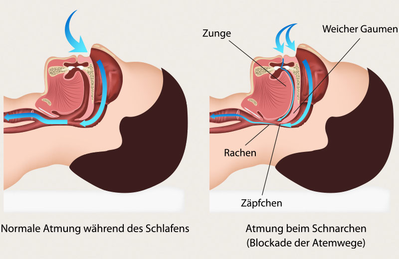 Ursachen von Schnarchen